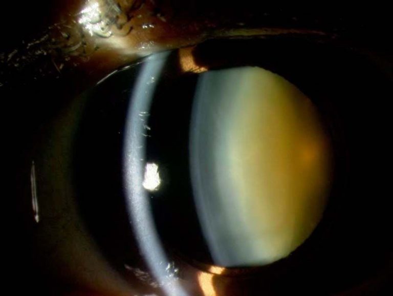 Cataract surgery slit lamp view