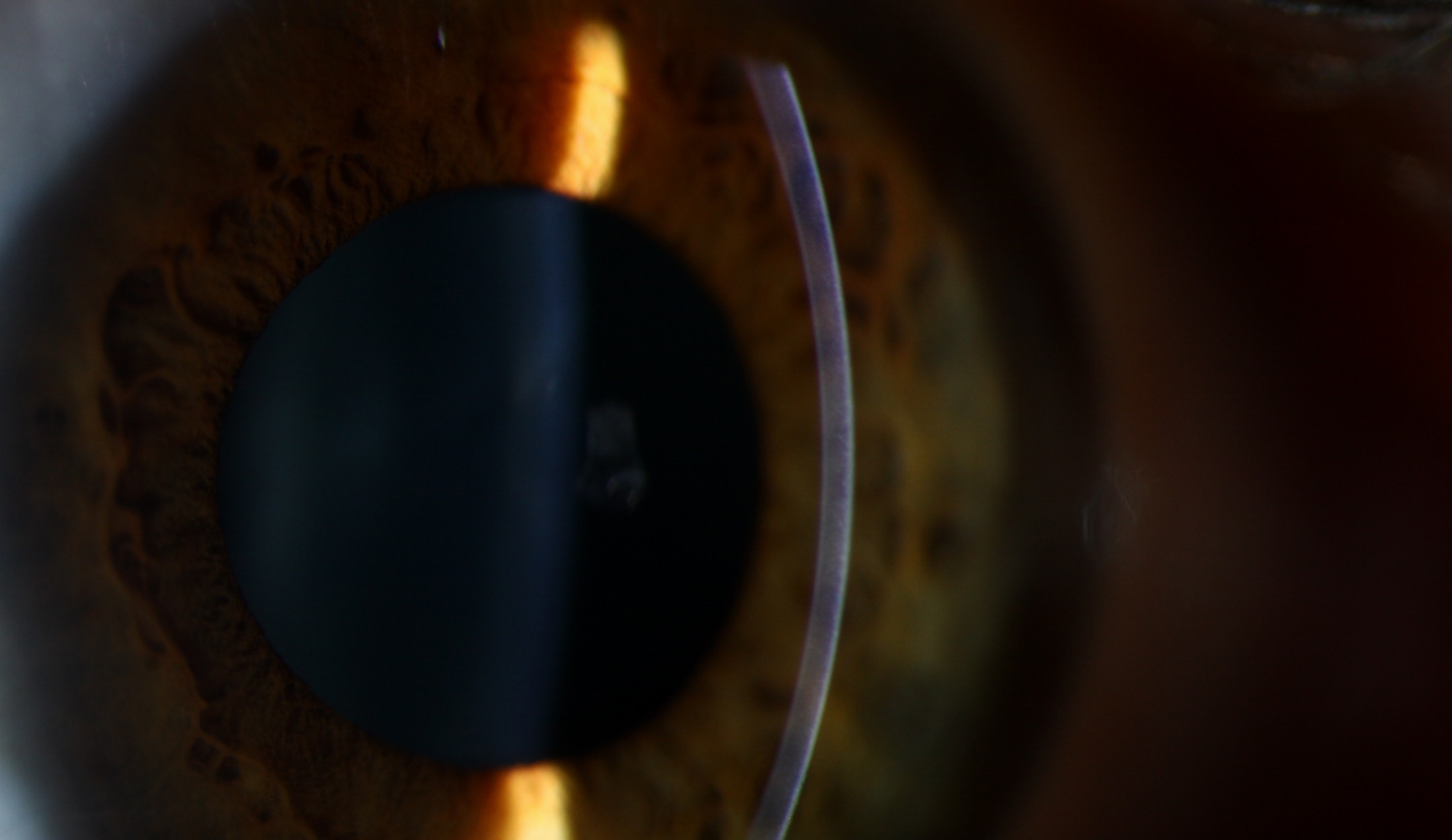 Corneal examination