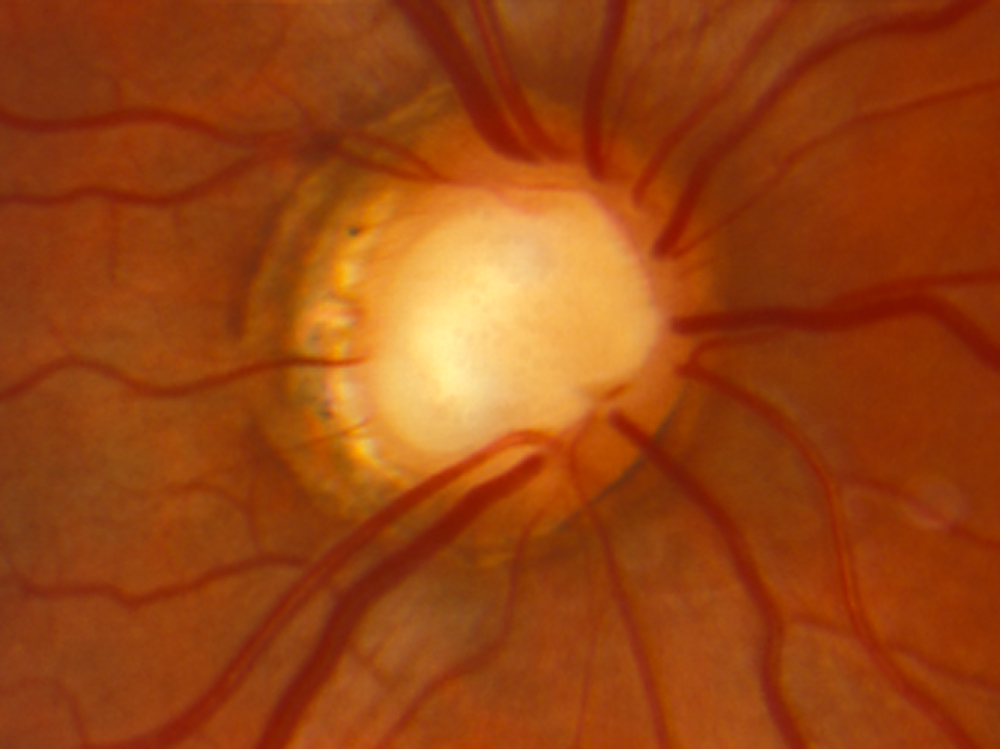 Glaucoma diagnostic imaging